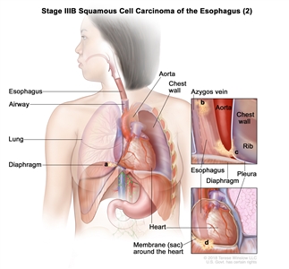 Stage IIIB squamous cell cancer of the esophagus (2); drawing shows cancer in the esophagus and in the (a) diaphragm, (b) azygos vein, (c) pleura, and (d) membrane (sac) around the heart. Also shown are the airway, lung, aorta, chest wall, heart, and rib.