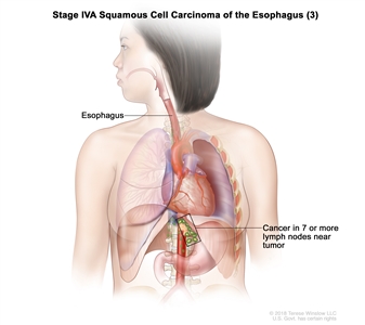 Stage IVA squamous cell cancer of the esophagus (3); drawing shows cancer in the esophagus and in 9 lymph nodes near the tumor.
