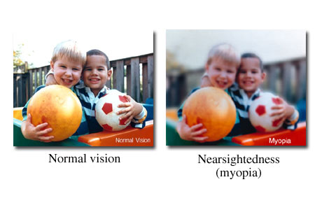 View through normal eye compared to nearsighted eye