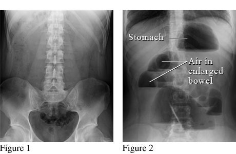 Abdominal X-ray of a bowel obstruction