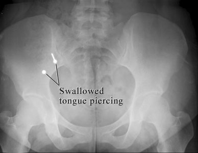 Image of swallowed tongue piercing