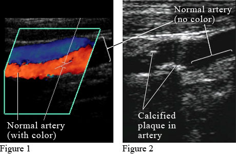 Doppler ultrasound images of arteries