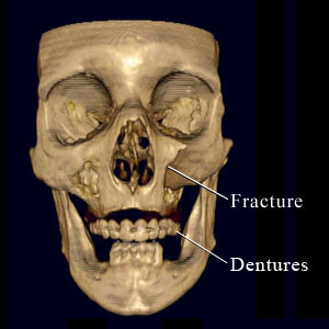 CT scan of facial fracture