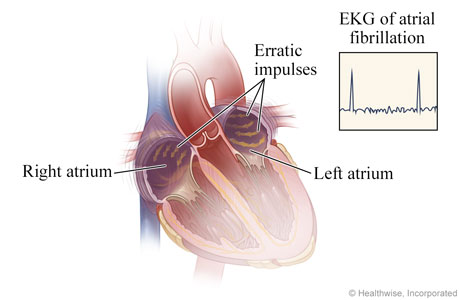 Erratic impulses in heart during atrial fibrillation, with abnormal EKG results