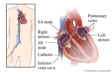 How a catheter is inserted through a vein to the heart