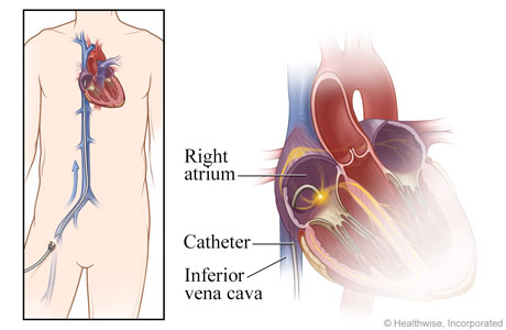 View of catheter from groin to heart, with detail of catheter in the atrium
