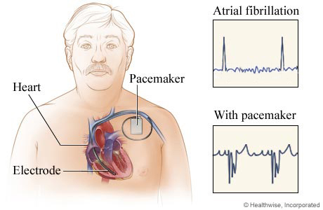 Location of pacemaker in chest, with before-and-after EKG results