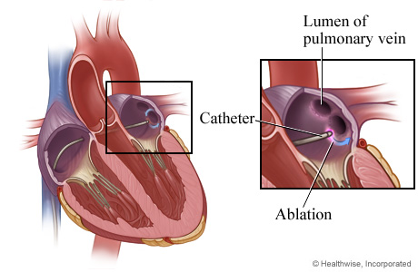 Heart tissue is destroyed (ablation)