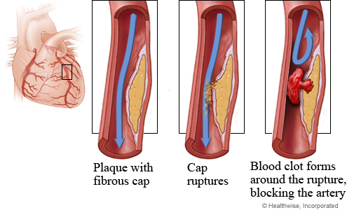 Plaque rupture and clot formation in a coronary artery