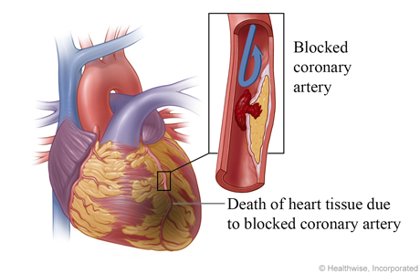 Blood clot completely blocks coronary artery, causing a heart attack and death of heart tissue