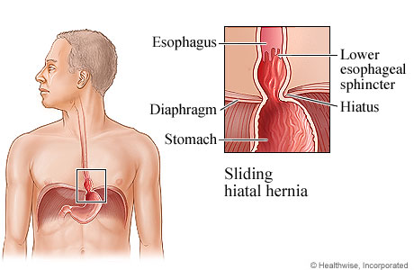 Picture of a sliding hiatal hernia