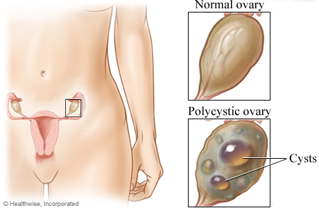 Picture of a normal ovary and a polycystic ovary