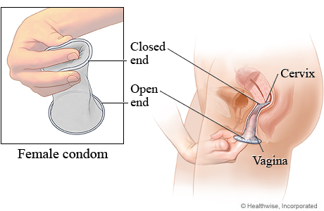 Female condom method of birth control