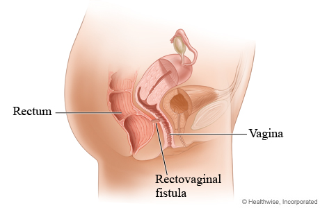 Picture of a rectovaginal fistula
