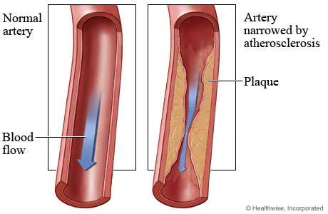 Normal coronary artery and blood flow and an artery narrowed by atherosclerosis