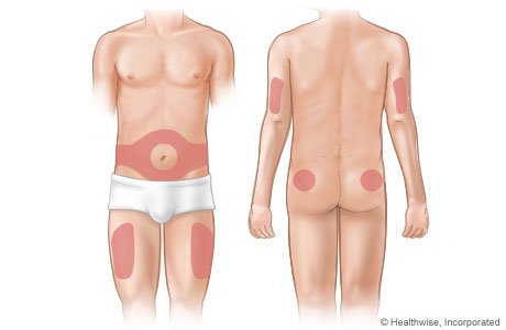 Areas on the body where insulin is injected