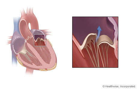 Location of mitral valve in the heart and detail of mitral valve regurgitation