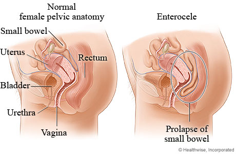 Small bowel prolapse
