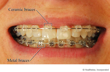 Mouth of someone with braces, showing ceramic braces on top and metal braces on the bottom