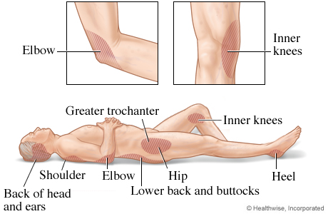 Areas where pressure injuries commonly develop