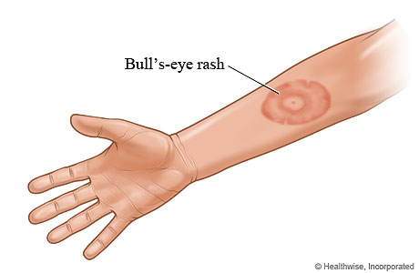 Picture of Lyme disease "bull's-eye" rash