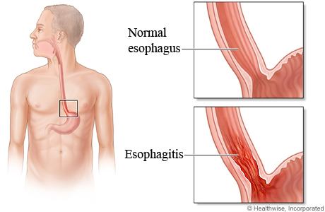 Normal esophagus compared to esophagitis