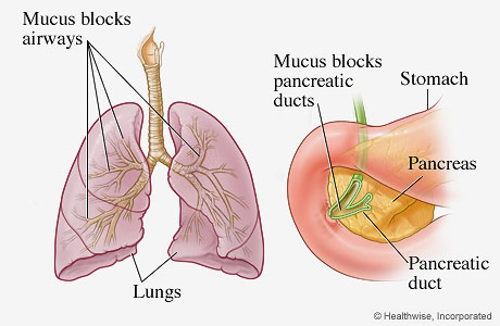 Organs most frequently affected by cystic fibrosis (lungs and pancreas)