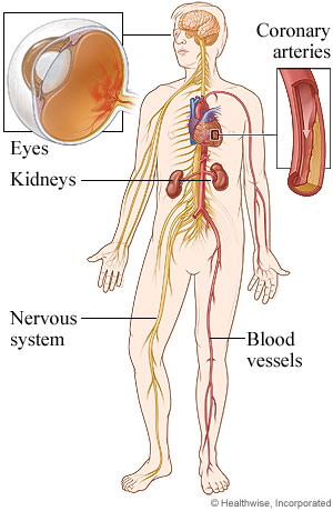 Body areas affected by diabetes