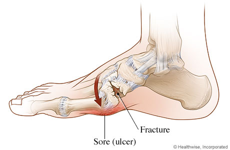 Picture of Charcot foot