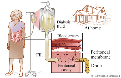 The process of peritoneal dialysis