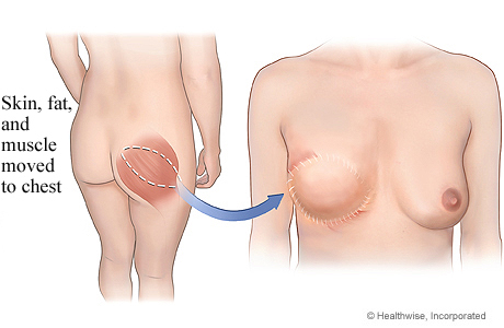 Gluteal free flap for breast reconstruction