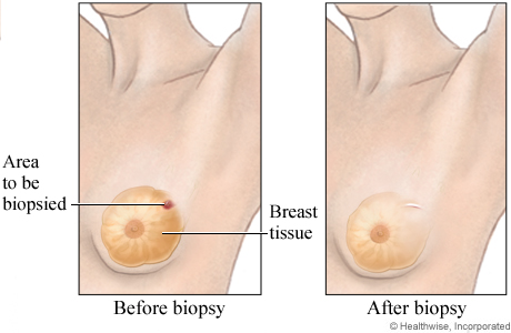 Open breast biopsy (before and after)