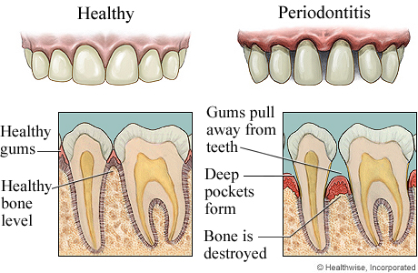 Healthy gums and advanced gum disease, with detail of both