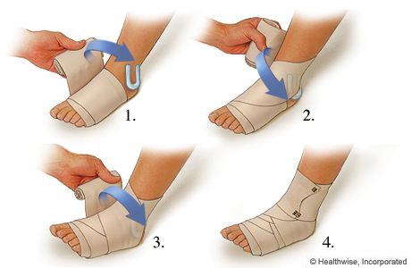 How to apply a compression wrap for a sprained ankle
