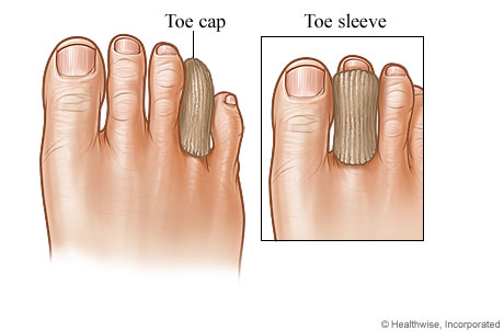 A toe cap on a toe and a toe sleeve on a toe