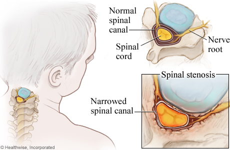 Picture of cervical spinal stenosis