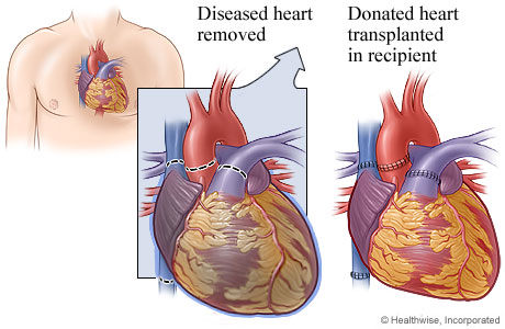 Diseased heart showing where blood vessels were detached and transplanted heart showing where blood vessels were attached