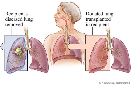 Picture of lung transplant
