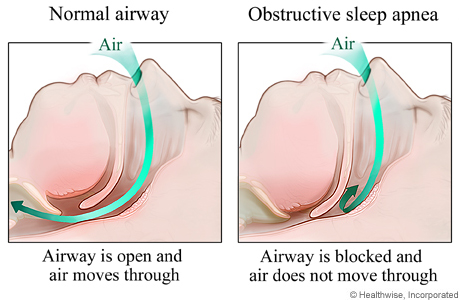 Normal airway and a blocked upper airway (obstructive sleep apnea)