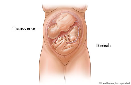 Breech and transverse twins in utero