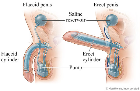 Picture of a penile implant