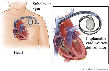Location of implantable cardioverter-defibrillator and connection to heart chambers