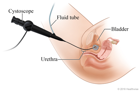 Picture of cystoscopy of the bladder