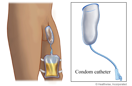 Condom catheter