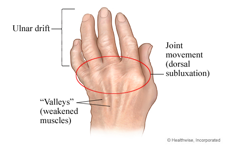 Picture of rheumatoid arthritis in the hand
