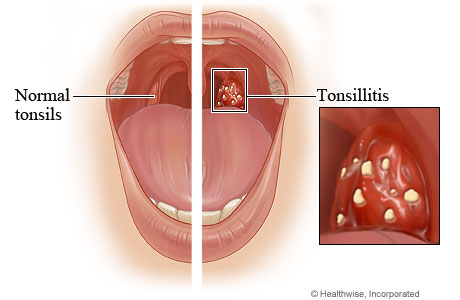Tonsillitis compared with normal tonsils
