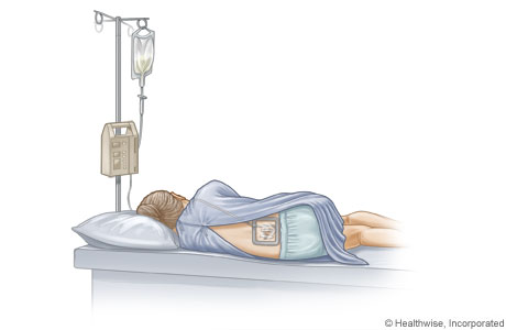 Catéter epidural colocado