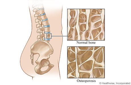 Healthy bone compared to bone weakened by osteoporosis