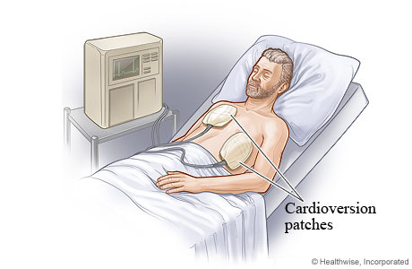 Electrical cardioversion with patches on chest