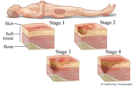 The four stages of pressure injuries